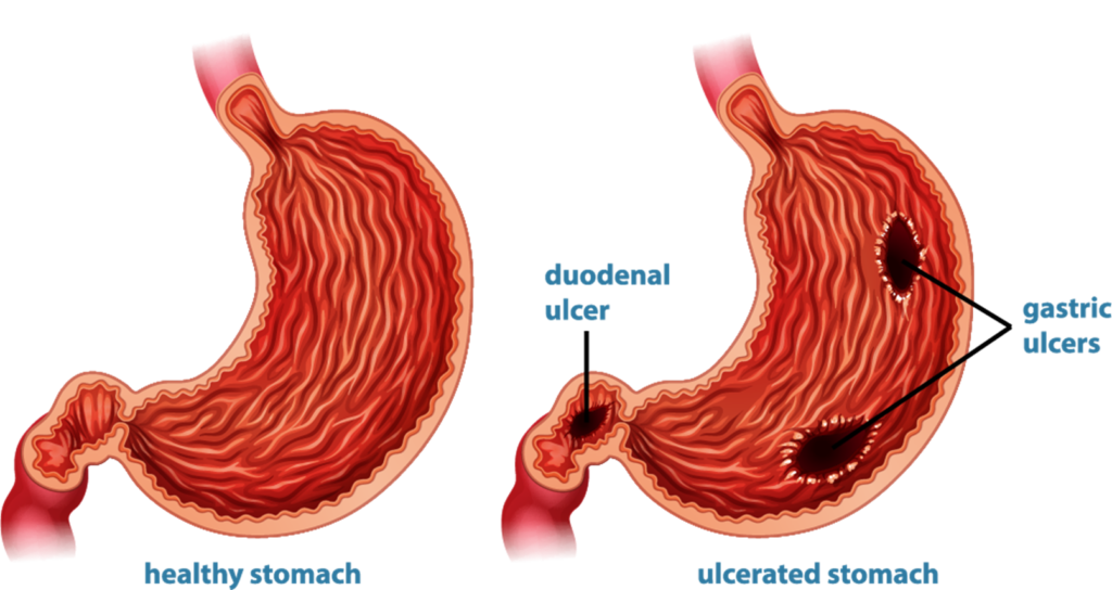 Peptic Ulcer