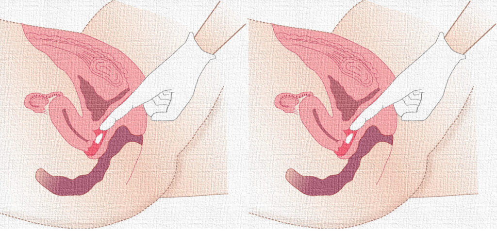 Vaginal drug delivery 