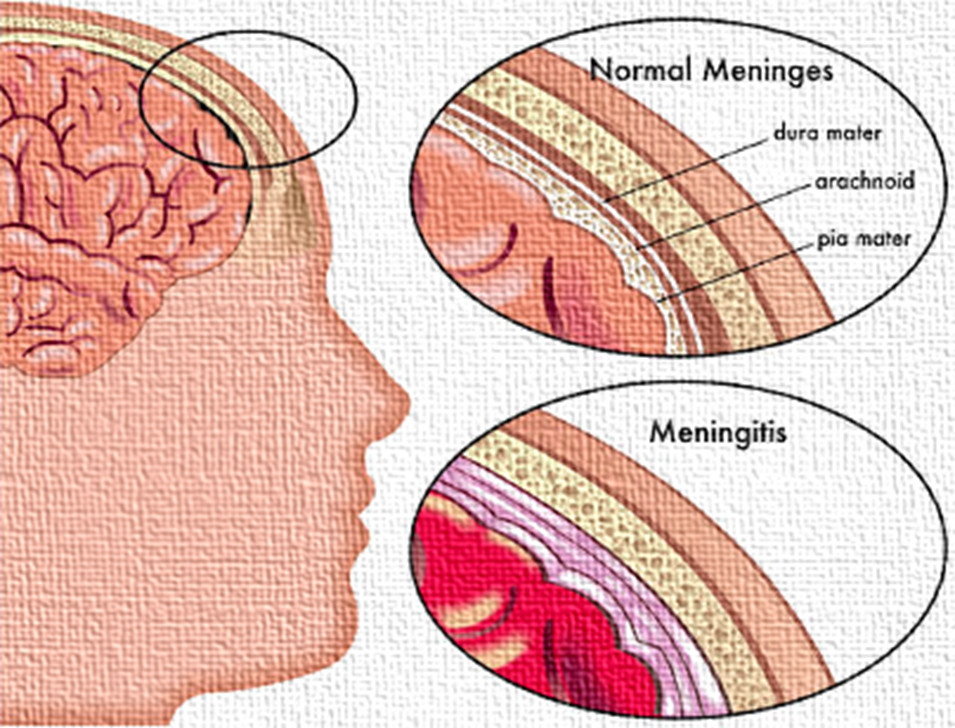 Meningitis 