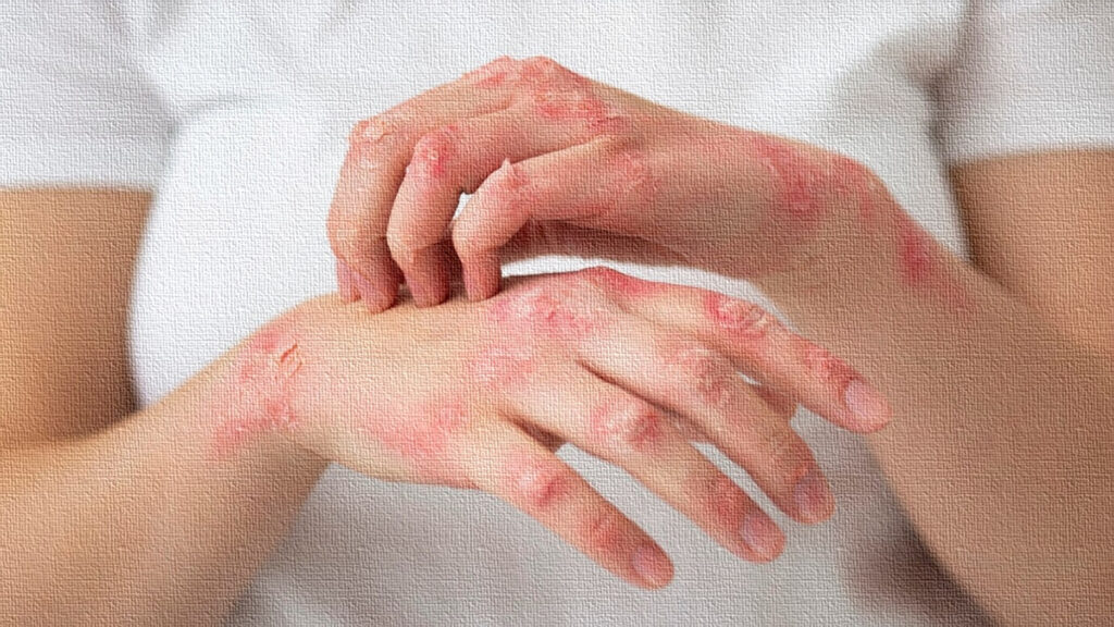 Leprosy 