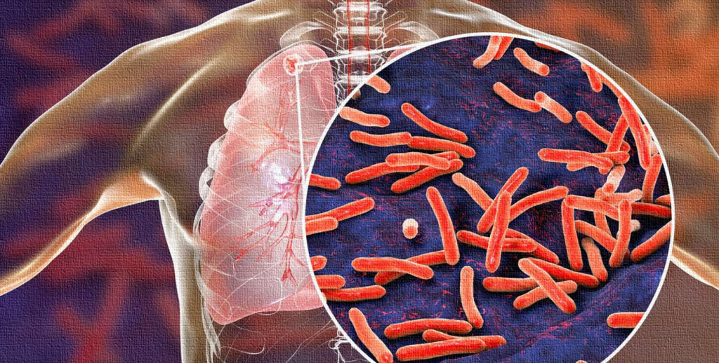 Tuberculosis 
